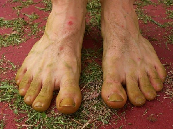 Bug Bite Barefoot